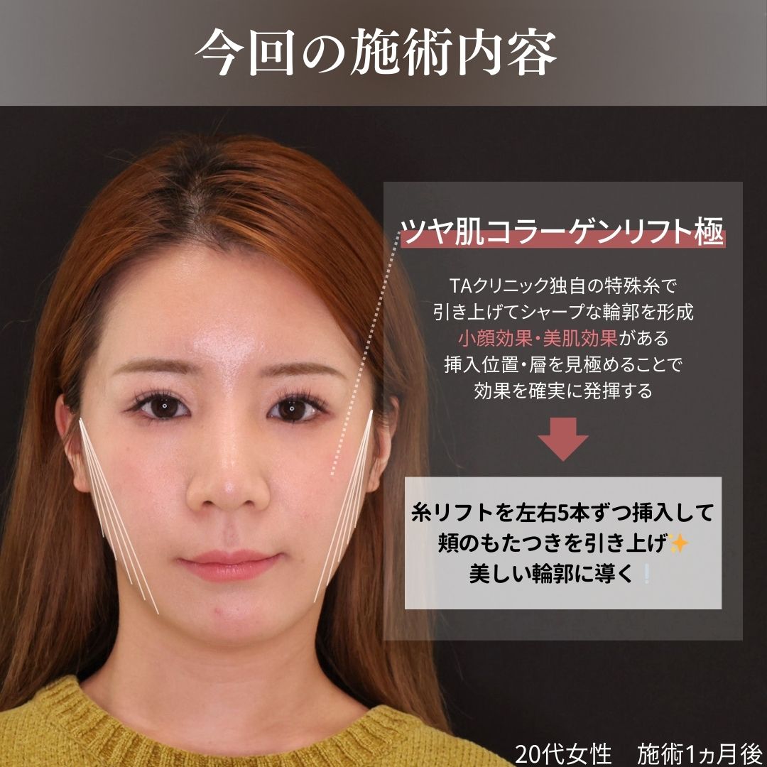 TAC式 ツヤ肌コラーゲンリフト®の症例写真 施術前後 