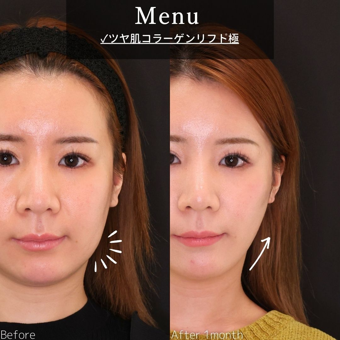 TAC式 ツヤ肌コラーゲンリフト®の症例写真 施術前後 