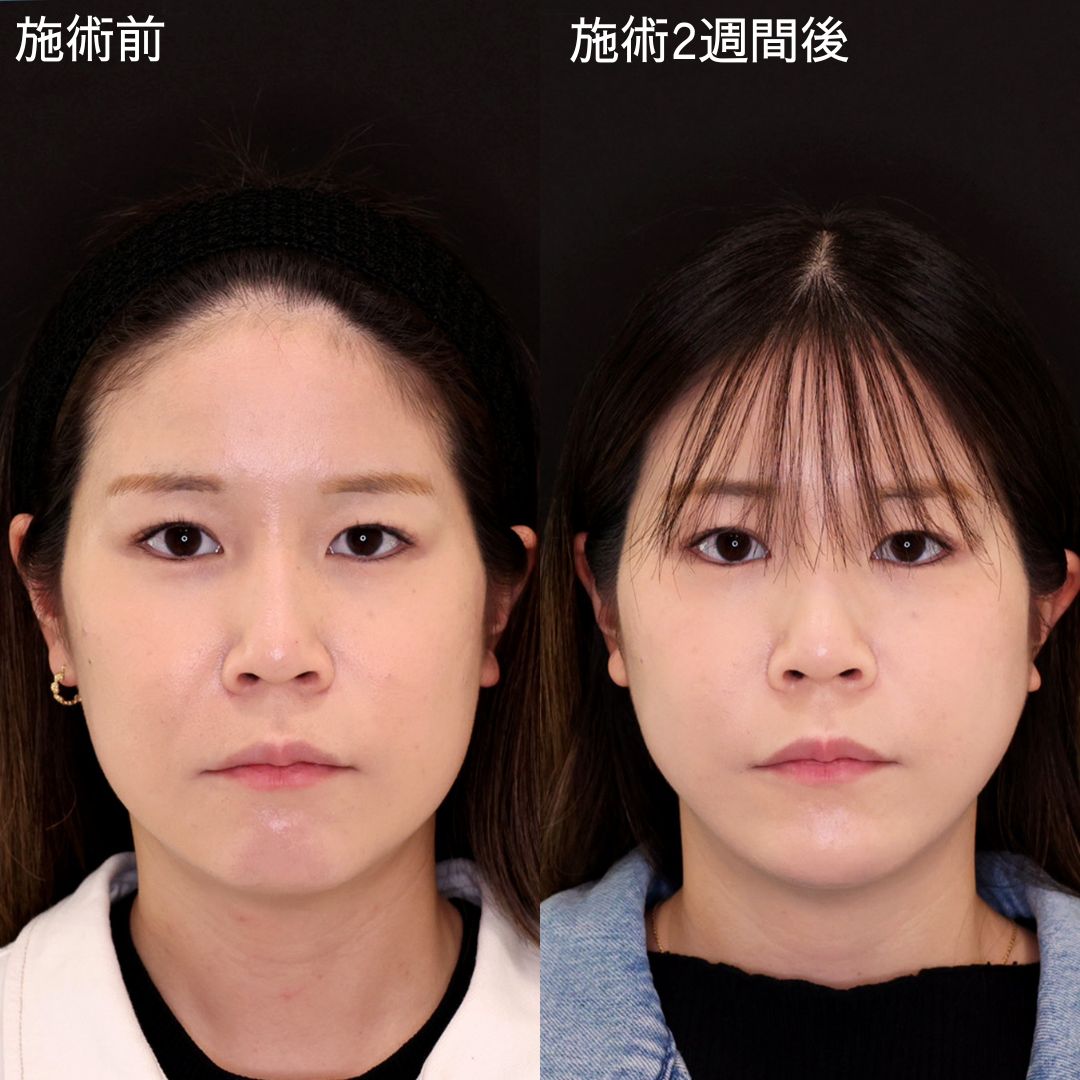 鼻先 左右差 改善の症例写真・画像・ビフォーアフター｜美容整形
