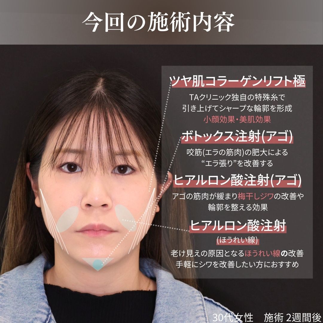 TAC式 ツヤ肌コラーゲンリフト®/顎のヒアルロン酸注射/ほうれい線のヒアルロン酸注射の症例写真 施術前後 