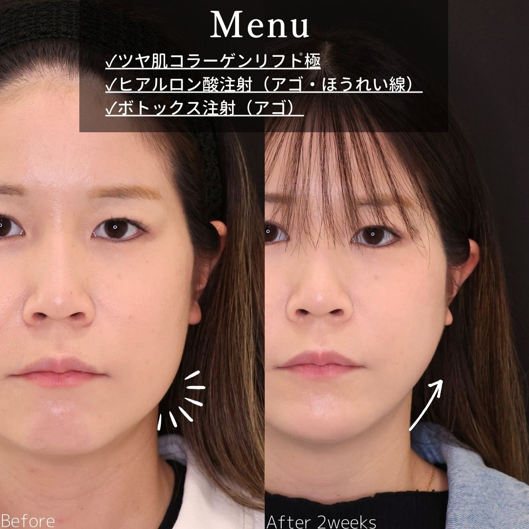 TAC式 ツヤ肌コラーゲンリフト®/顎のヒアルロン酸注射/ほうれい線のヒアルロン酸注射の症例写真 施術前後 
