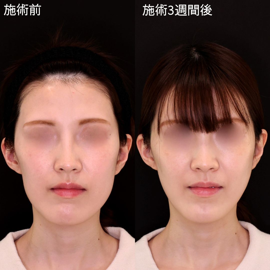 コンプレックスを糸で解消する！面長改善リフト【糸リフト】