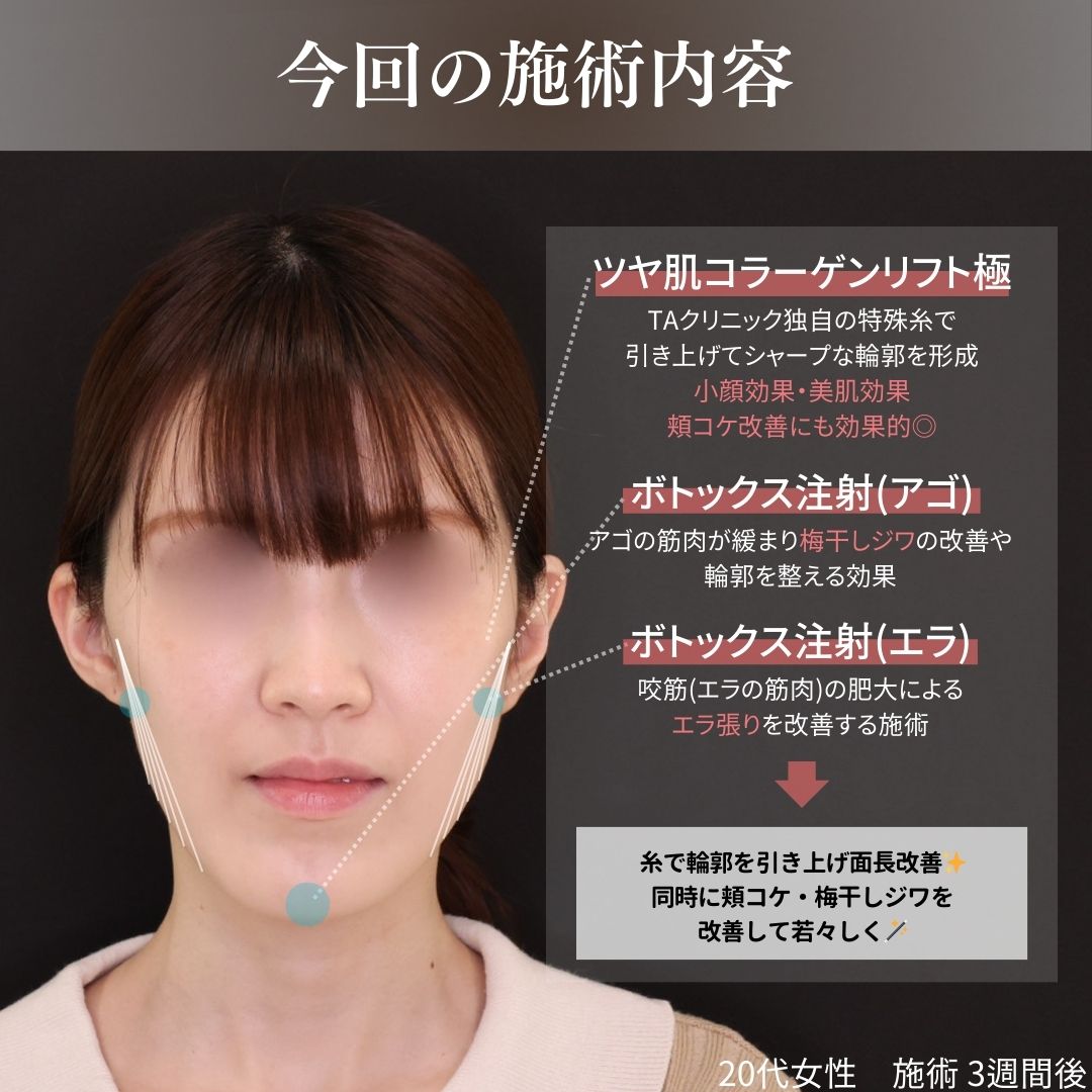 TAC式 ツヤ肌コラーゲンリフト®/エラボトックス注射の症例写真 施術前後 
