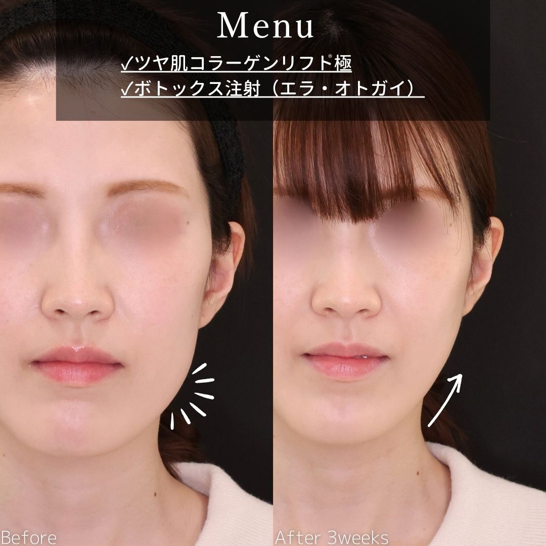 TAC式 ツヤ肌コラーゲンリフト®/エラボトックス注射の症例写真 施術前後 