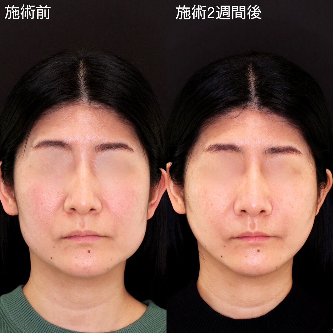 ヒアルロン酸注射併用で若々しく！若返り小顔術【糸リフト×ヒアルロン酸注射】