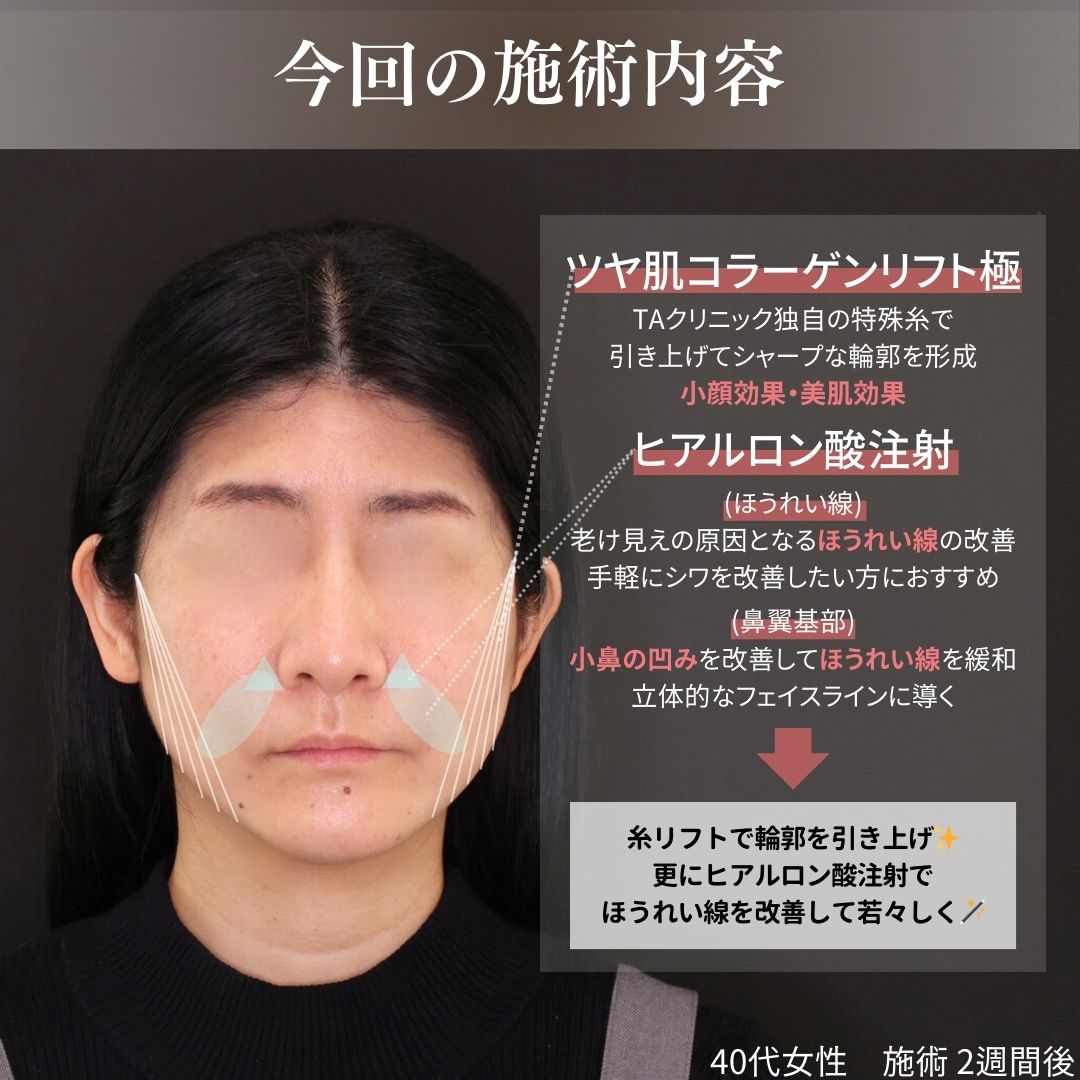 TAC式 ツヤ肌コラーゲンリフト®/ほうれい線のヒアルロン酸注射の症例写真 施術前後 