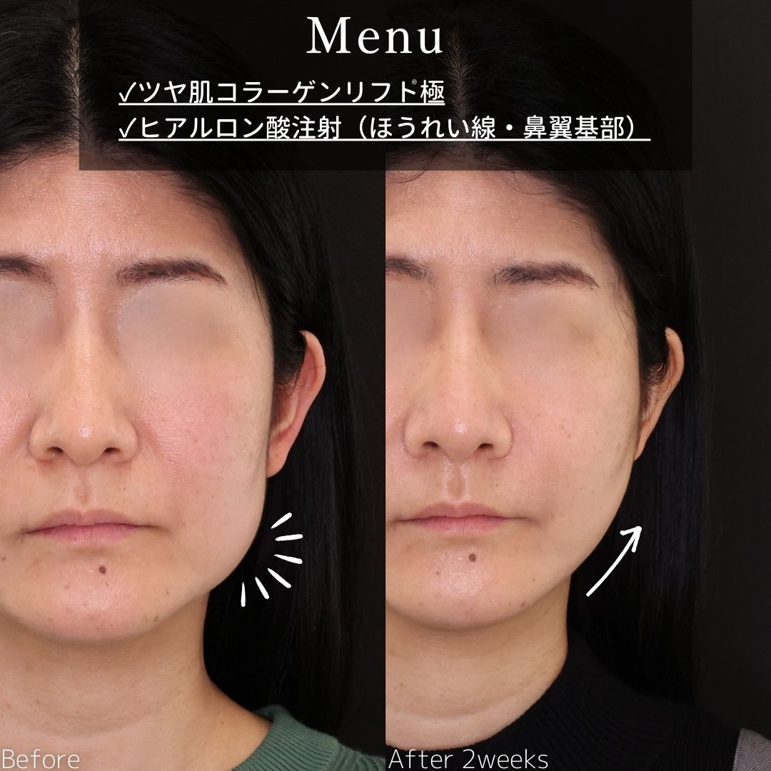 TAC式 ツヤ肌コラーゲンリフト®/ほうれい線のヒアルロン酸注射の症例写真 施術前後 