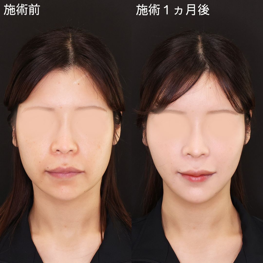 【糸リフト】ナチュラルに垢抜けるDr.石橋の糸リフト