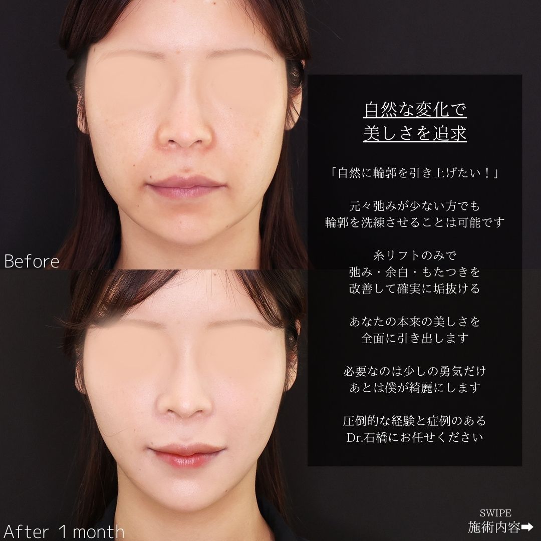 TAC式 ツヤ肌コラーゲンリフト®の症例写真 施術前後