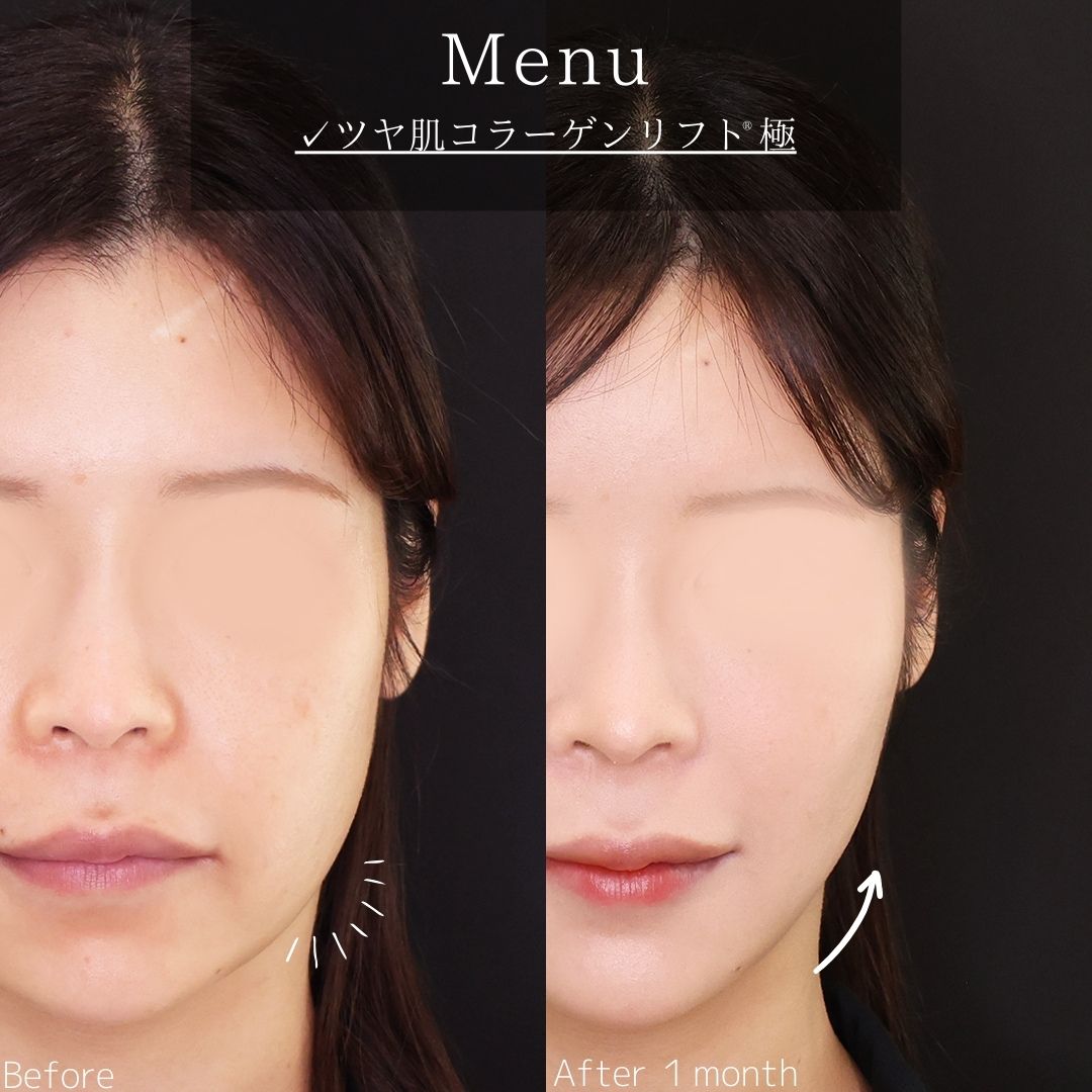 TAC式 ツヤ肌コラーゲンリフト®の症例写真 施術前後