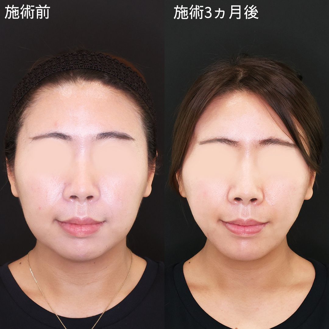 骨切りなしで輪郭洗練！アプリ級小顔術【糸リフト×脂肪吸引】