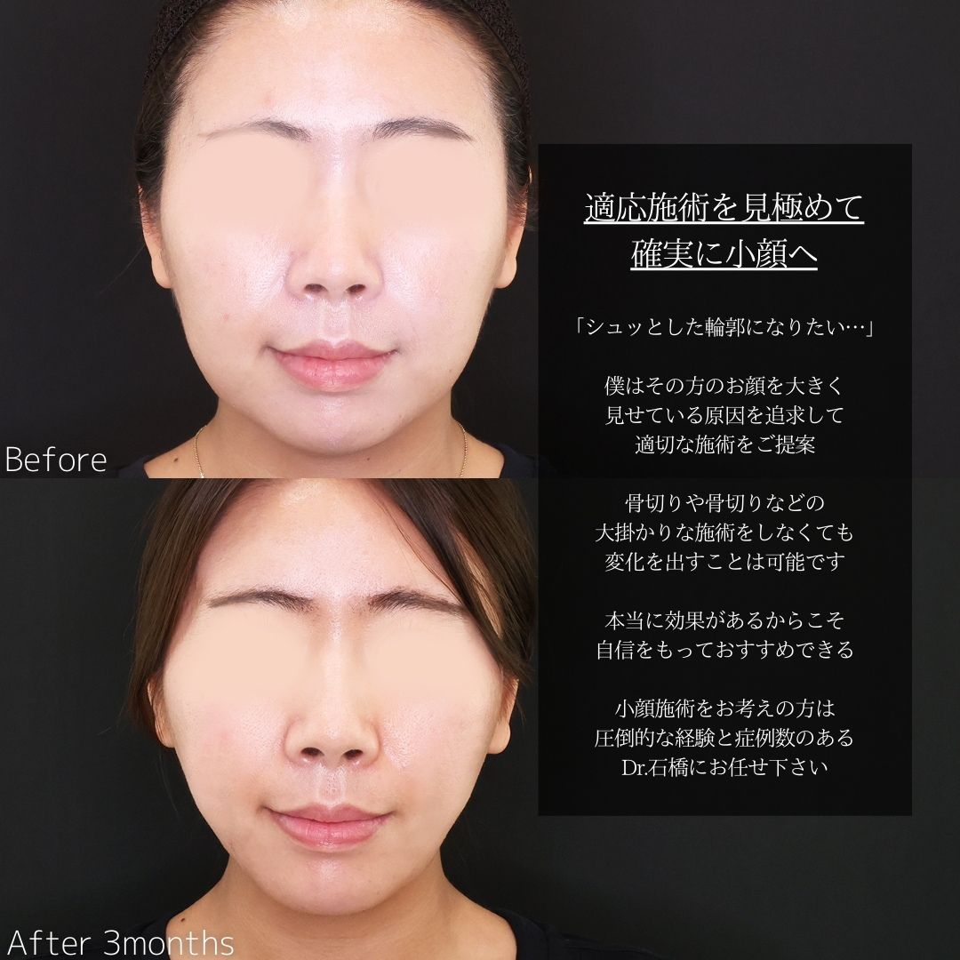TAC式 ツヤ肌コラーゲンリフト®/ジョールファット除去/顔の脂肪吸引の症例写真 施術前後 