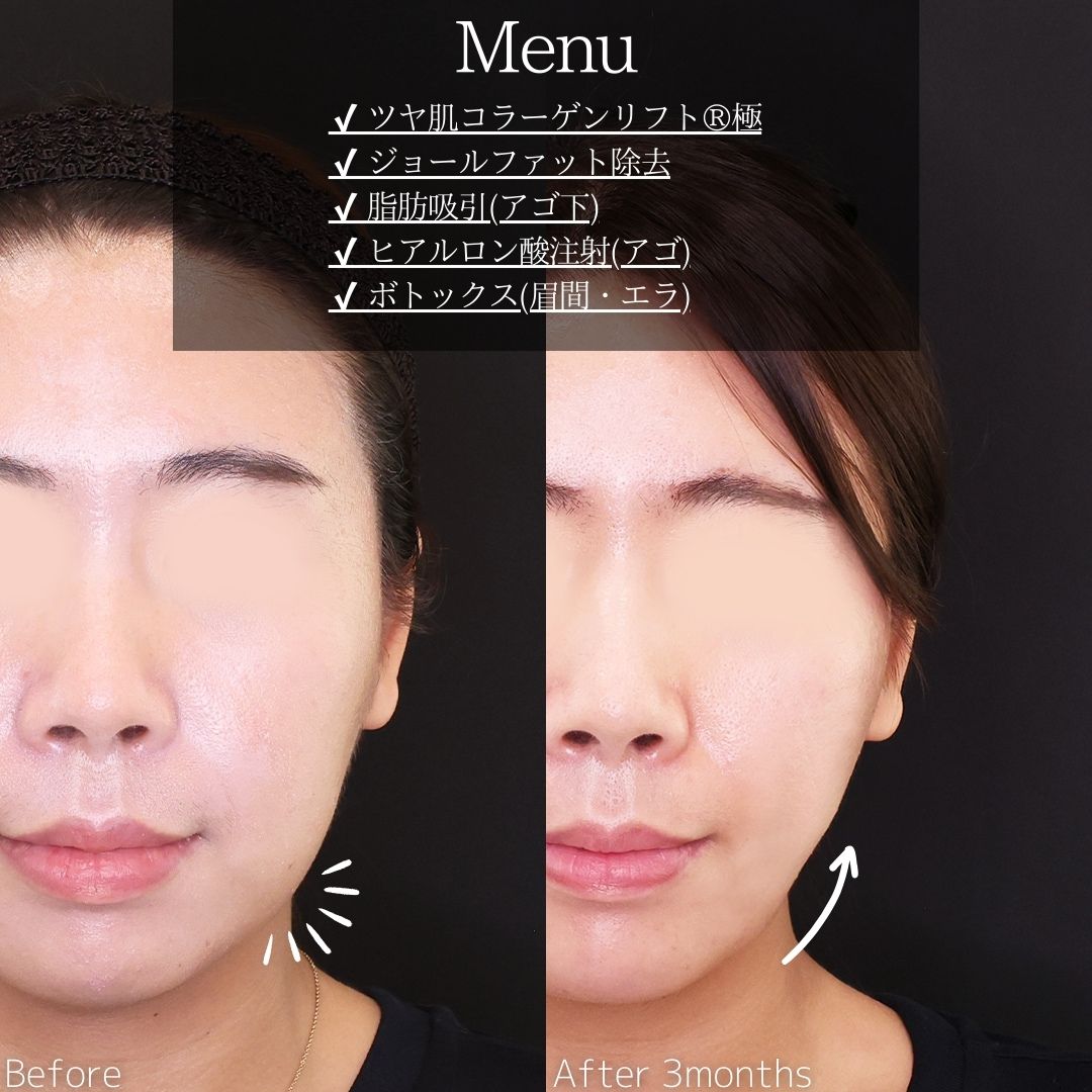 TAC式 ツヤ肌コラーゲンリフト®/ジョールファット除去/顔の脂肪吸引の症例写真 施術前後 