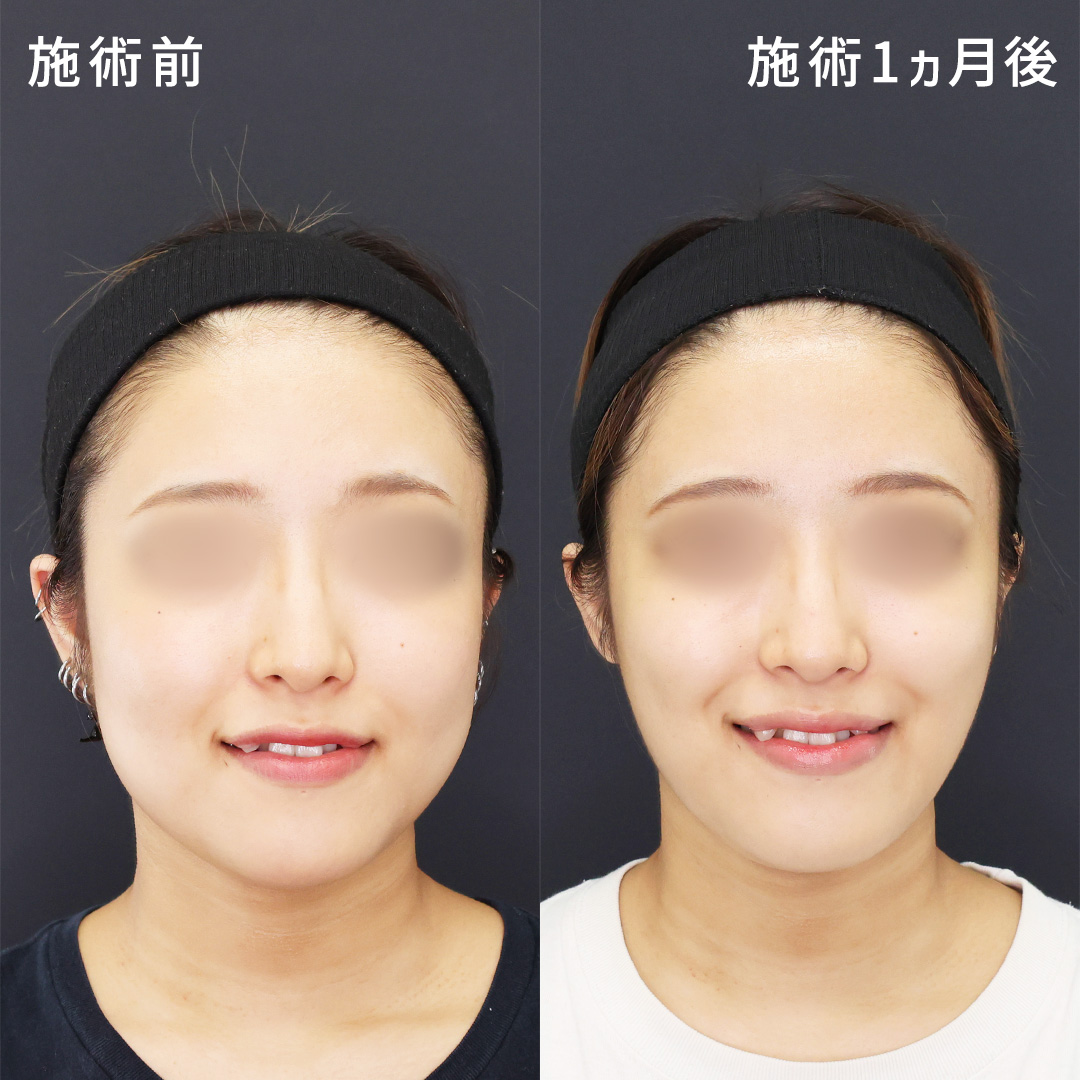 笑顔のポコっとお肉も解消【バッカルファット除去×Lラインファット除去】