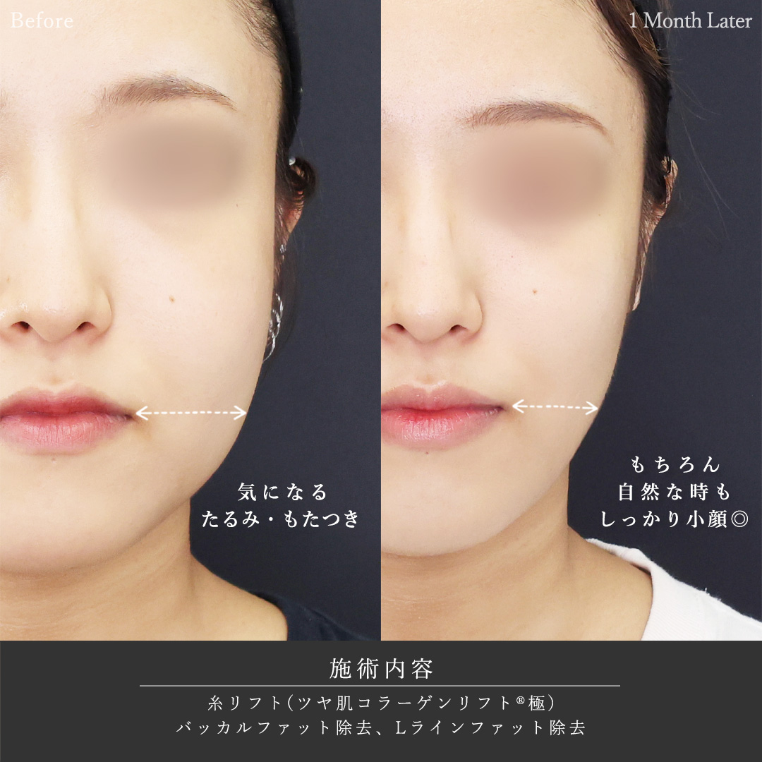 TAC式 ツヤ肌コラーゲンリフト®/バッカルファット除去/Lラインファット除去（エラ下脂肪除去）の症例写真 施術前後 