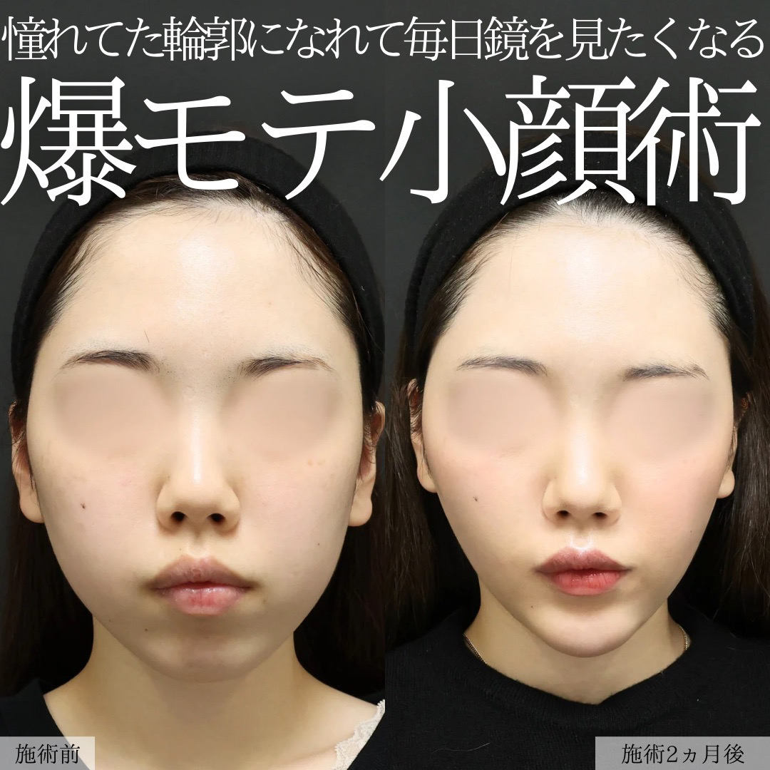 TAC式 ツヤ肌コラーゲンリフト®/バッカルファット除去/ジョールファット除去の症例写真 施術前後 