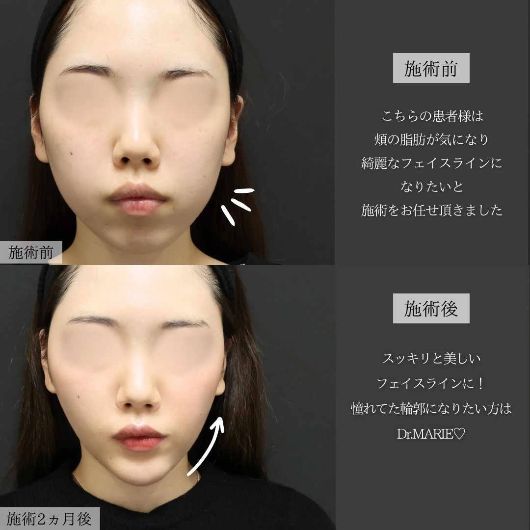 TAC式 ツヤ肌コラーゲンリフト®/バッカルファット除去/ジョールファット除去の症例写真 施術前後 