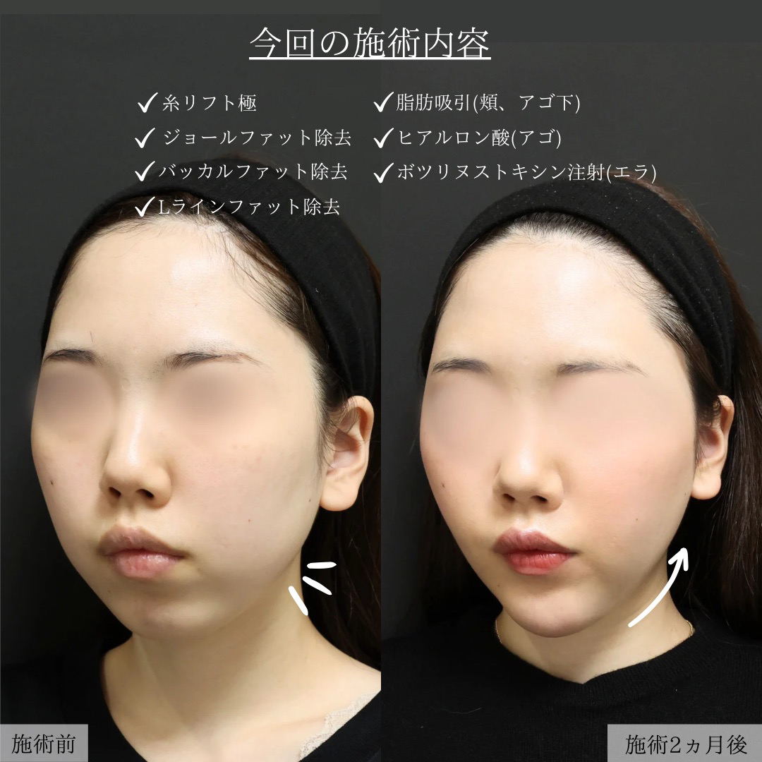 TAC式 ツヤ肌コラーゲンリフト®/バッカルファット除去/ジョールファット除去の症例写真 施術前後 