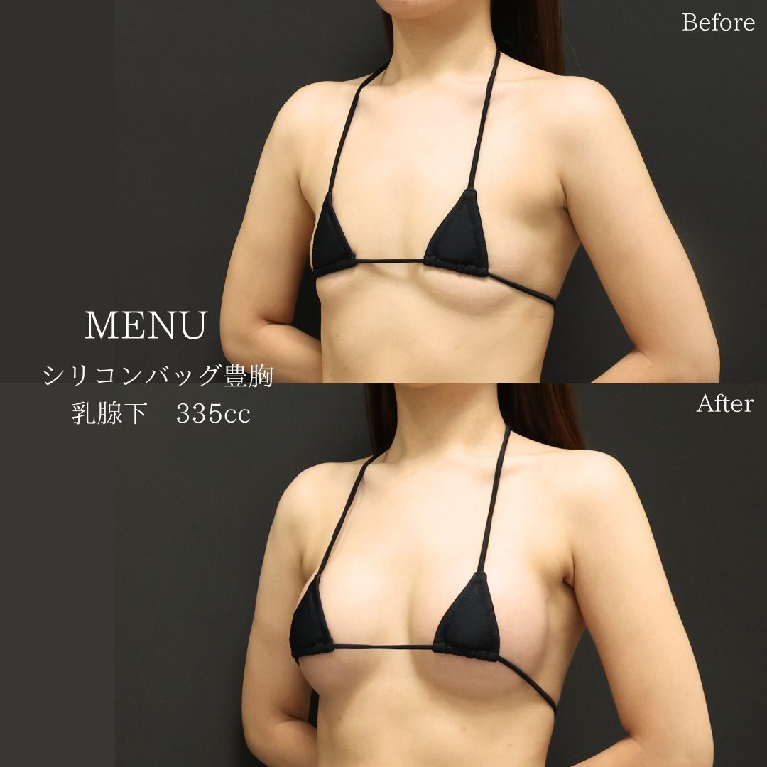 シリコンバッグ豊胸（人工乳腺バッグ）の症例写真 施術前後 