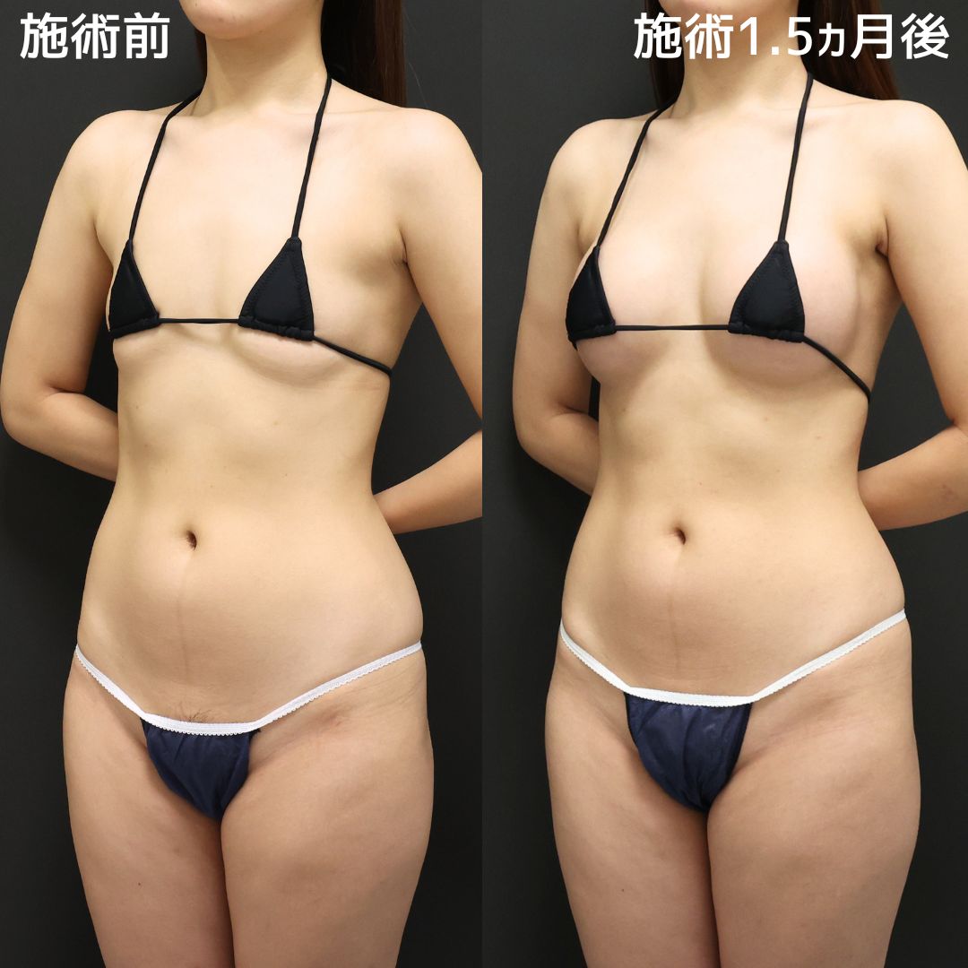 《シリコンバッグ豊胸》理想に合わせて自然にバストアップ!