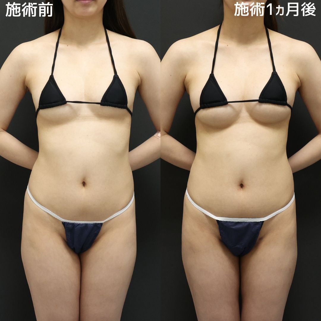 《脂肪注入豊胸》大きくしても見た目も触り心地も自然なバストに