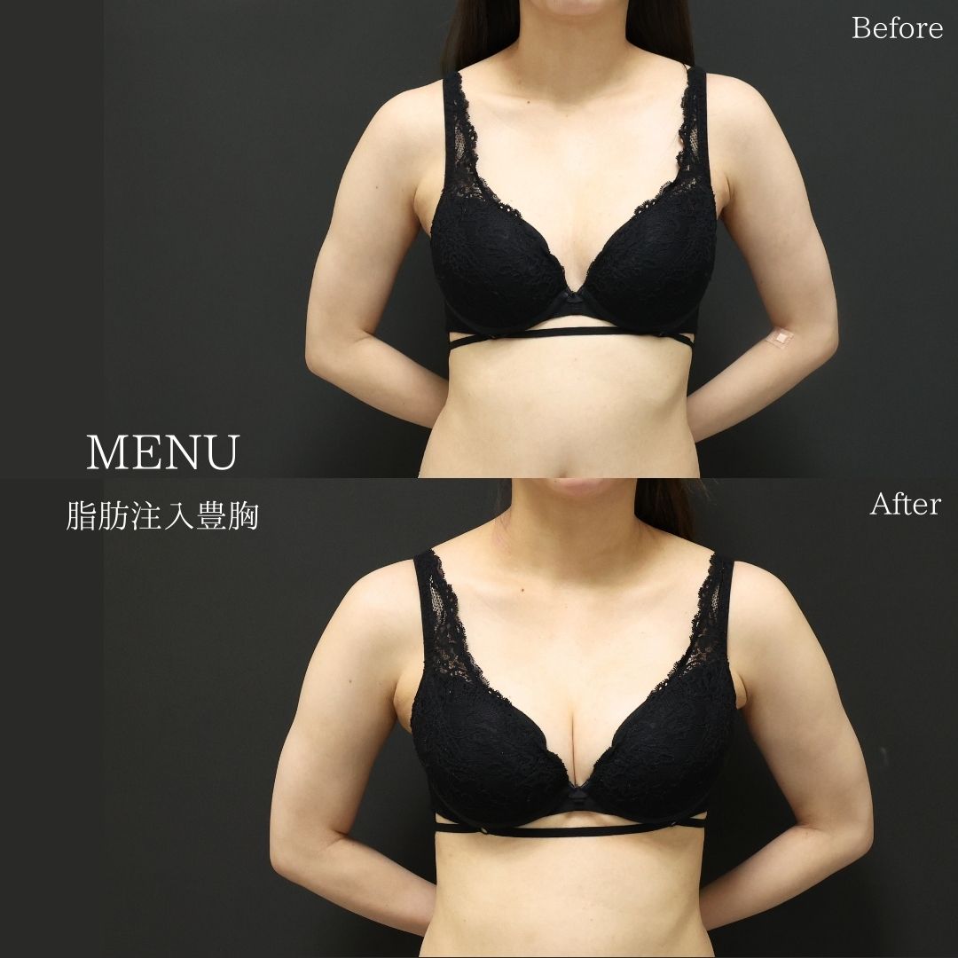 脂肪注入豊胸（コンデンスリッチ・ピュアグラフト・１day脂肪豊胸）の症例写真 施術前後 