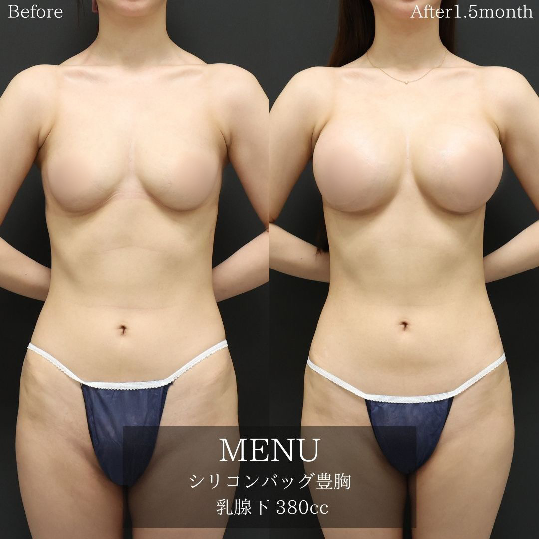 シリコンバッグ豊胸（人工乳腺バッグ）の症例写真 施術前後 