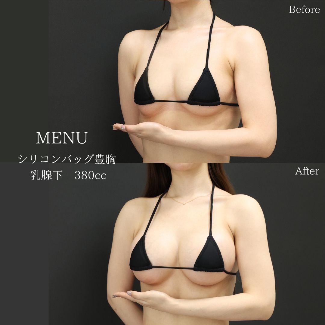 シリコンバッグ豊胸（人工乳腺バッグ）の症例写真 施術前後 