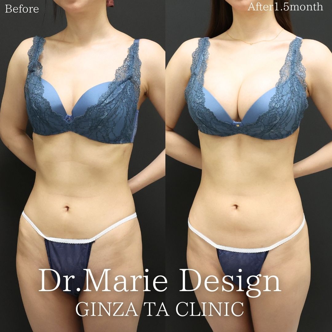 シリコンバッグ豊胸（人工乳腺バッグ）の症例写真 施術前後 