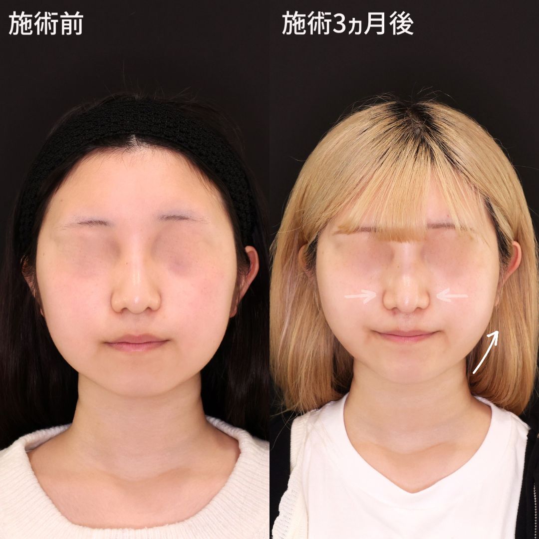 鼻尖形成・鼻尖縮小/TAC式 ツヤ肌コラーゲンリフト®/顔の脂肪吸引の症例写真 施術前後