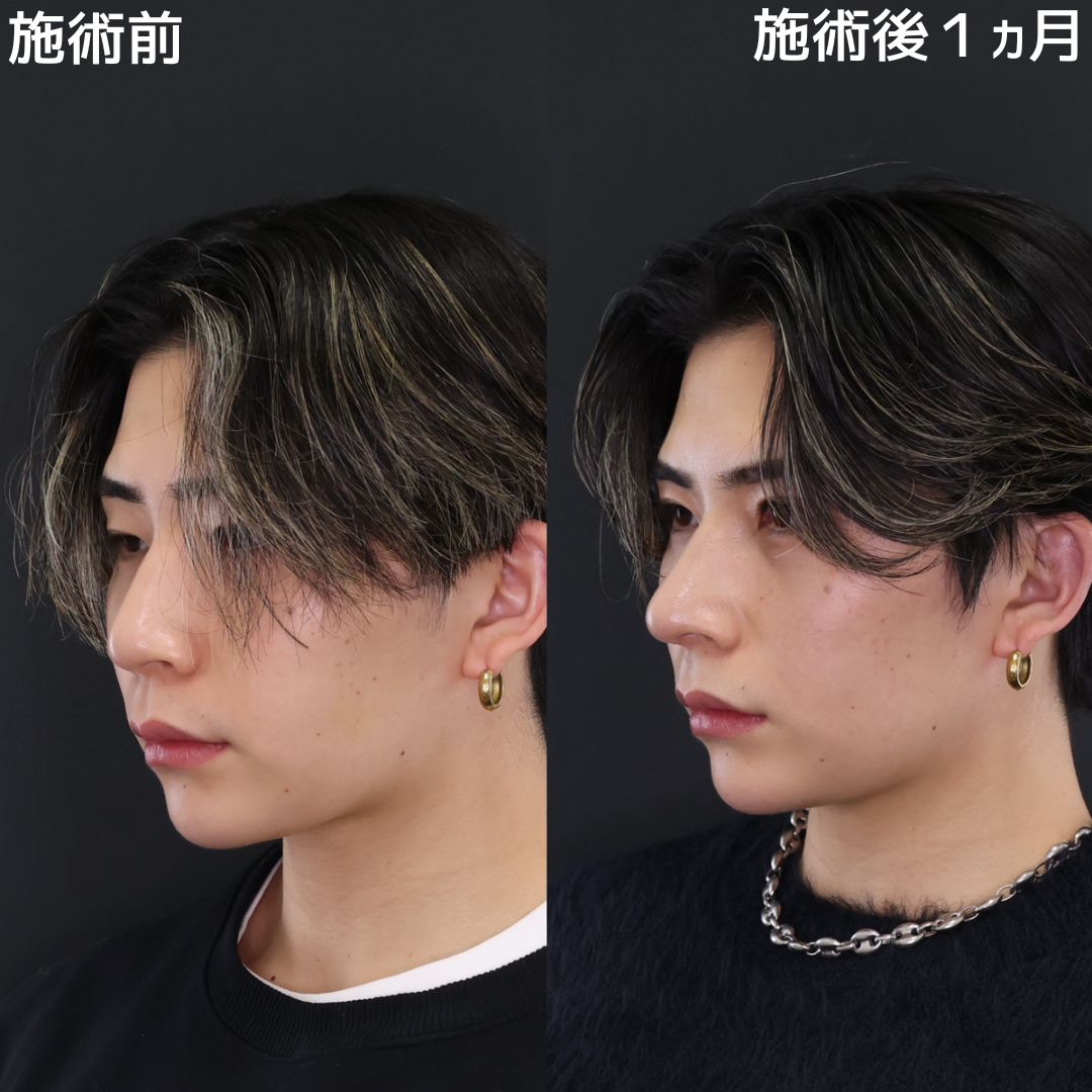 鼻中隔延長術/鼻先軟骨移植/鼻尖形成・鼻尖縮小の症例写真 施術前後 
