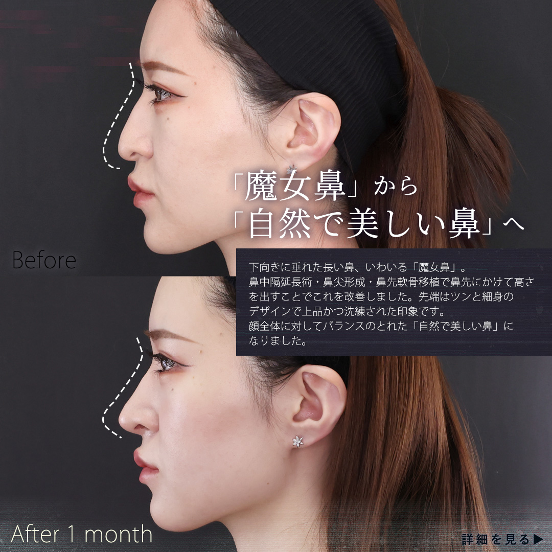 鼻中隔延長術/鼻先軟骨移植/鼻尖形成・鼻尖縮小の症例写真 施術前後 