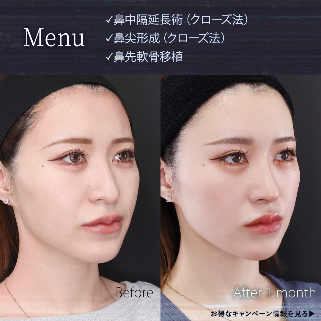 鼻中隔延長術/鼻先軟骨移植/鼻尖形成・鼻尖縮小の症例写真 施術前後 