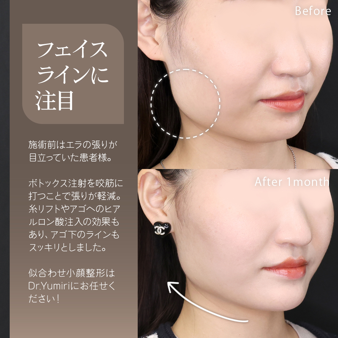 TAC式 ツヤ肌コラーゲンリフト®/エラボトックス注射/顎のヒアルロン酸注射の症例写真 施術前後 