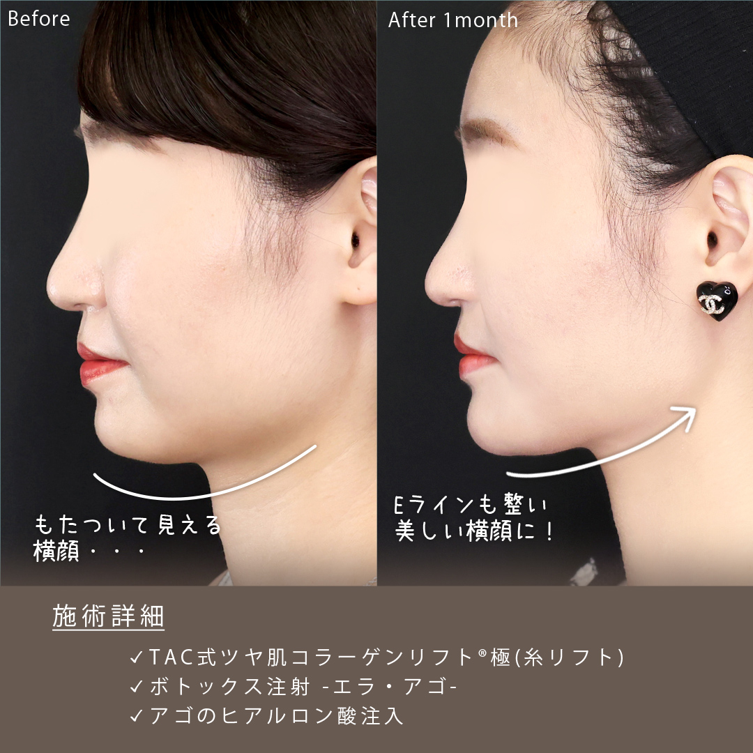 TAC式 ツヤ肌コラーゲンリフト®/エラボトックス注射/顎のヒアルロン酸注射の症例写真 施術前後 