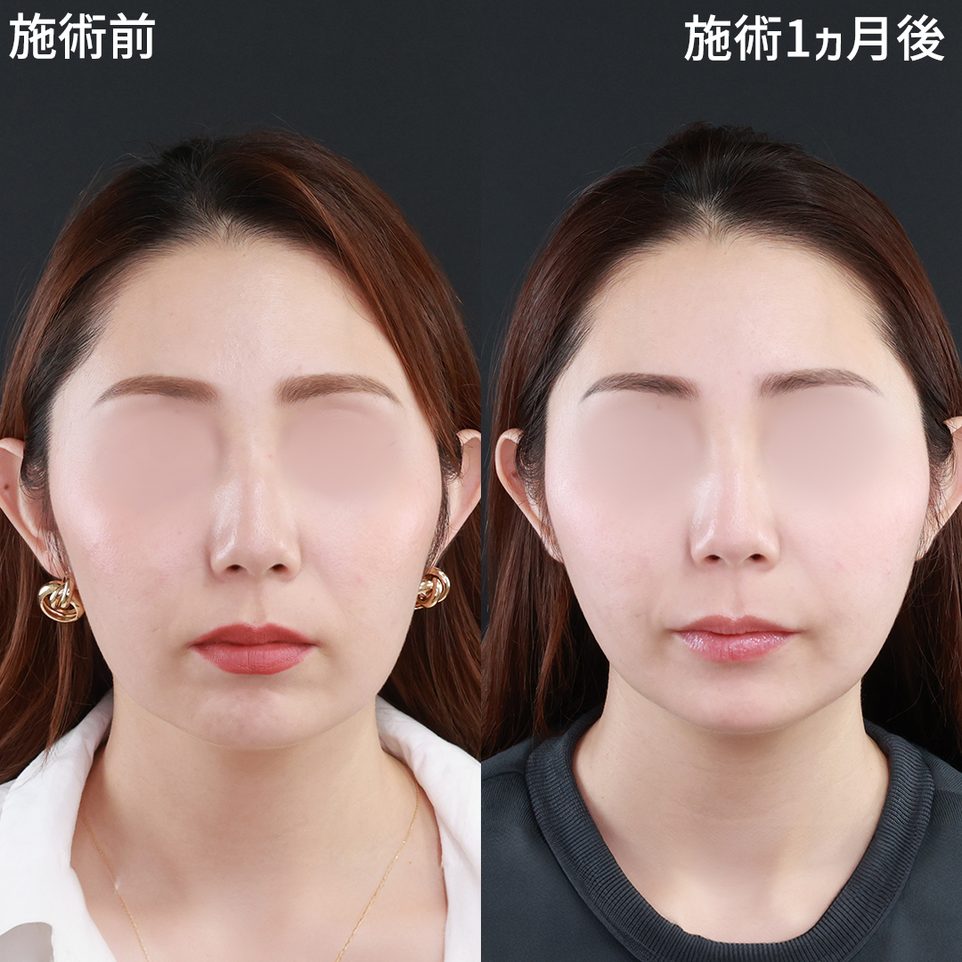 たるみとほうれい線を改善し、美人度アップ