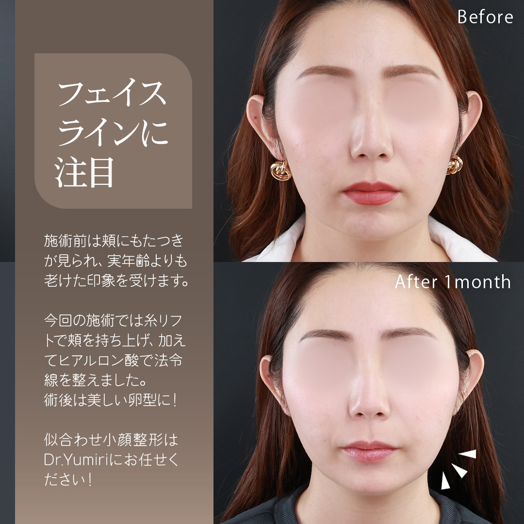 TAC式 ツヤ肌コラーゲンリフト®/ほうれい線のヒアルロン酸注射/ヒアルロン酸注射：その他の症例写真 施術前後 