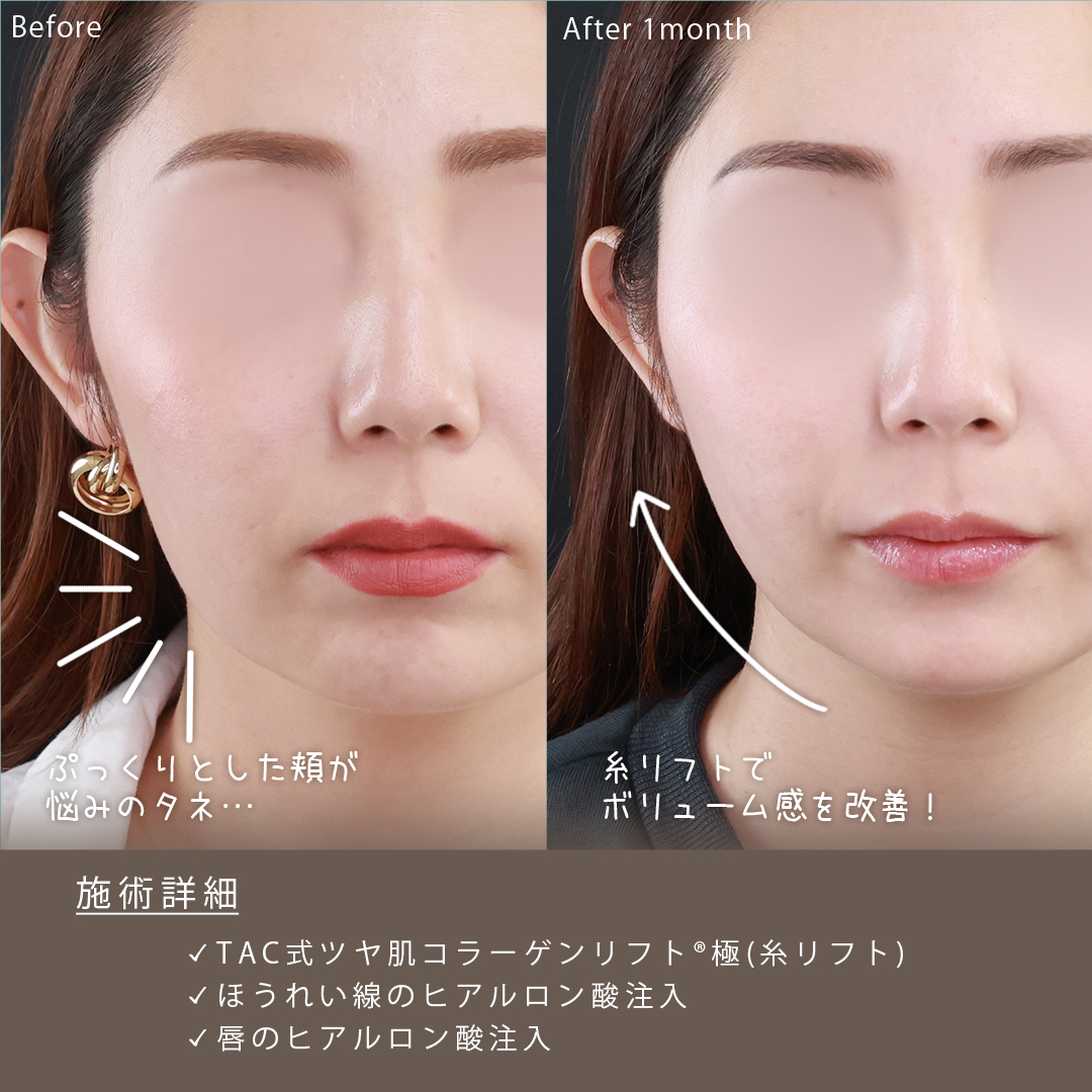 TAC式 ツヤ肌コラーゲンリフト®/ほうれい線のヒアルロン酸注射/ヒアルロン酸注射：その他の症例写真 施術前後 