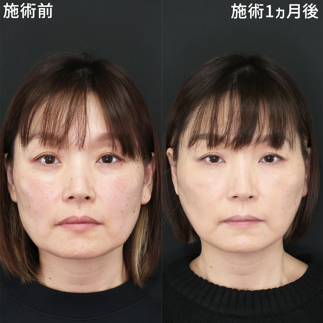 TAC式 ツヤ肌コラーゲンリフト®/顔の脂肪注入(コンデンスリッチフェイス)の症例写真 施術前後