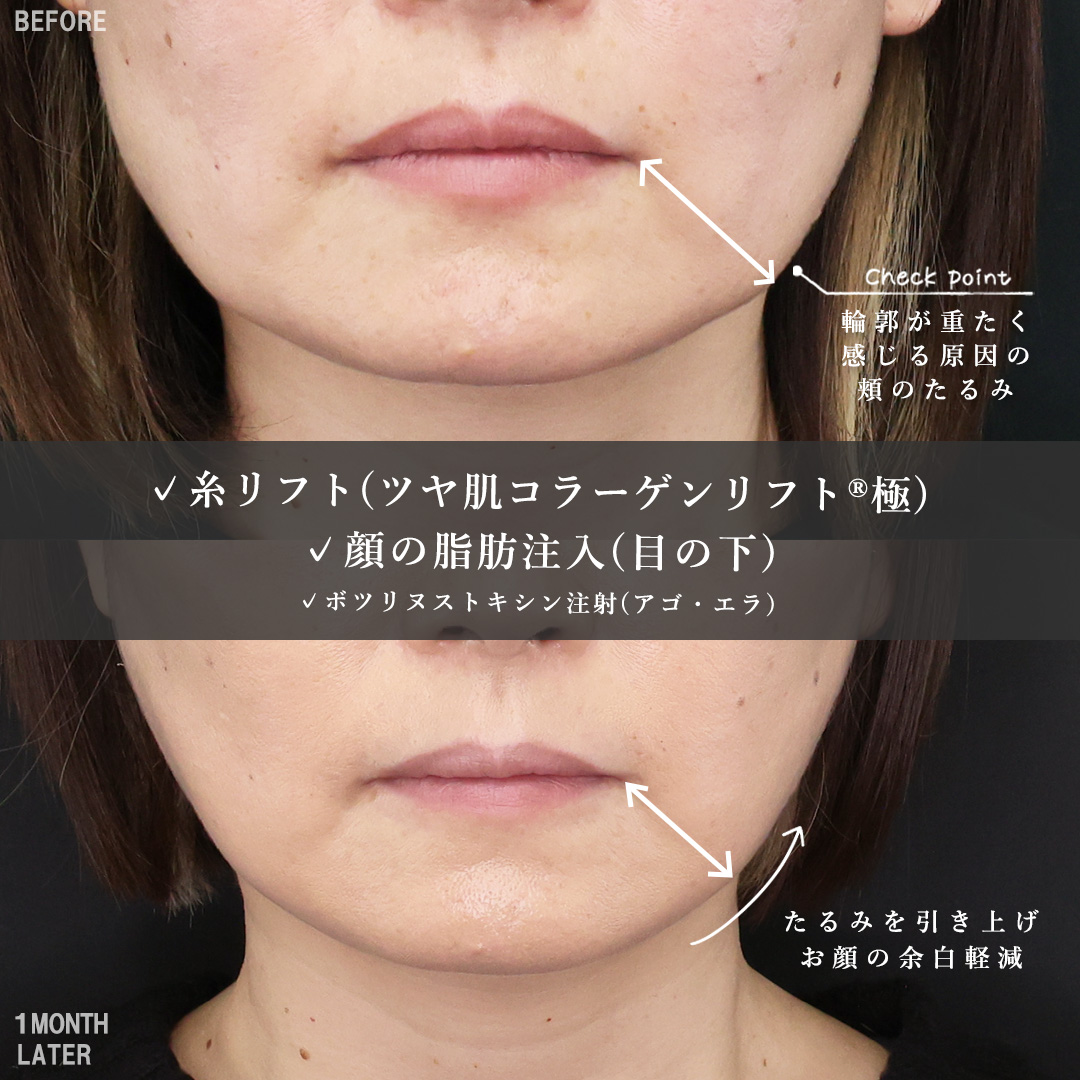 TAC式 ツヤ肌コラーゲンリフト®/顔の脂肪注入(コンデンスリッチフェイス)の症例写真 施術前後
