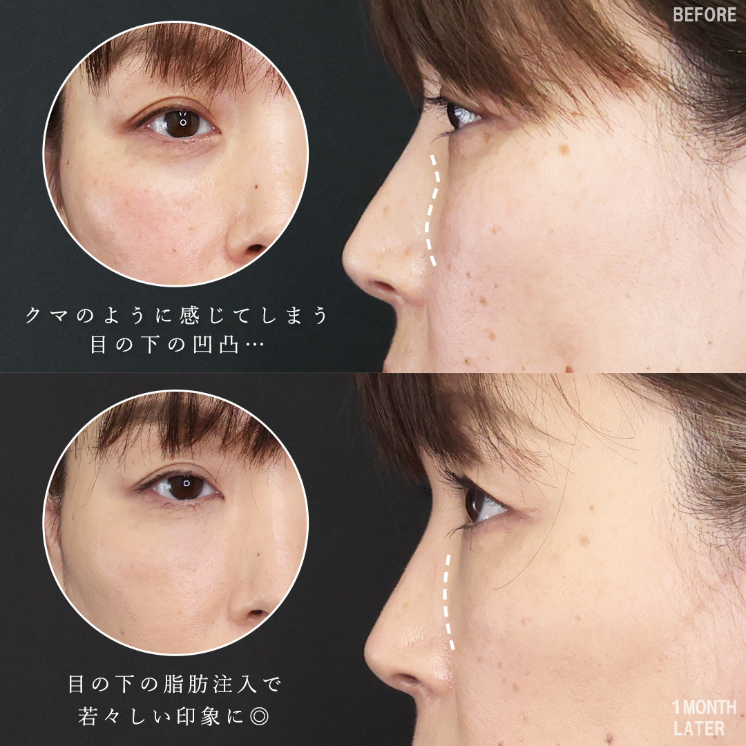 TAC式 ツヤ肌コラーゲンリフト®/顔の脂肪注入(コンデンスリッチフェイス)の症例写真 施術前後