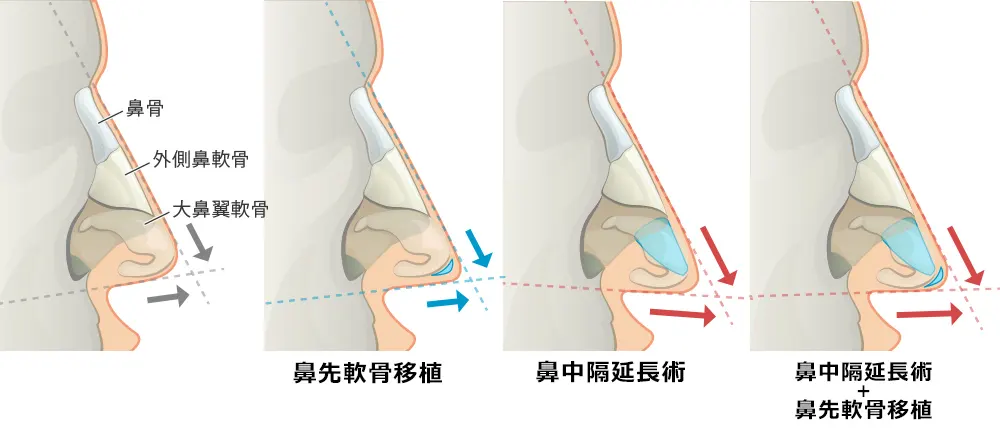 鼻中隔延長術/鼻先軟骨移植/鼻尖形成・鼻尖縮小の症例写真 施術前後 