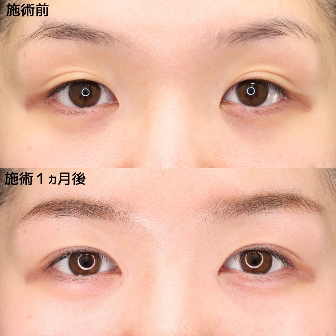 《二重埋没×目頭切開》眠そうな目元から大人可愛いお目元へ