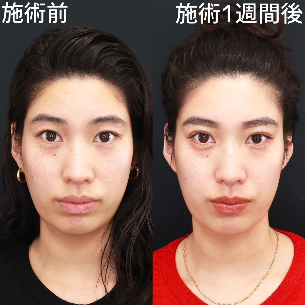 【クイックコスメリング】二重幅を広げてお顔の印象も華やかに！