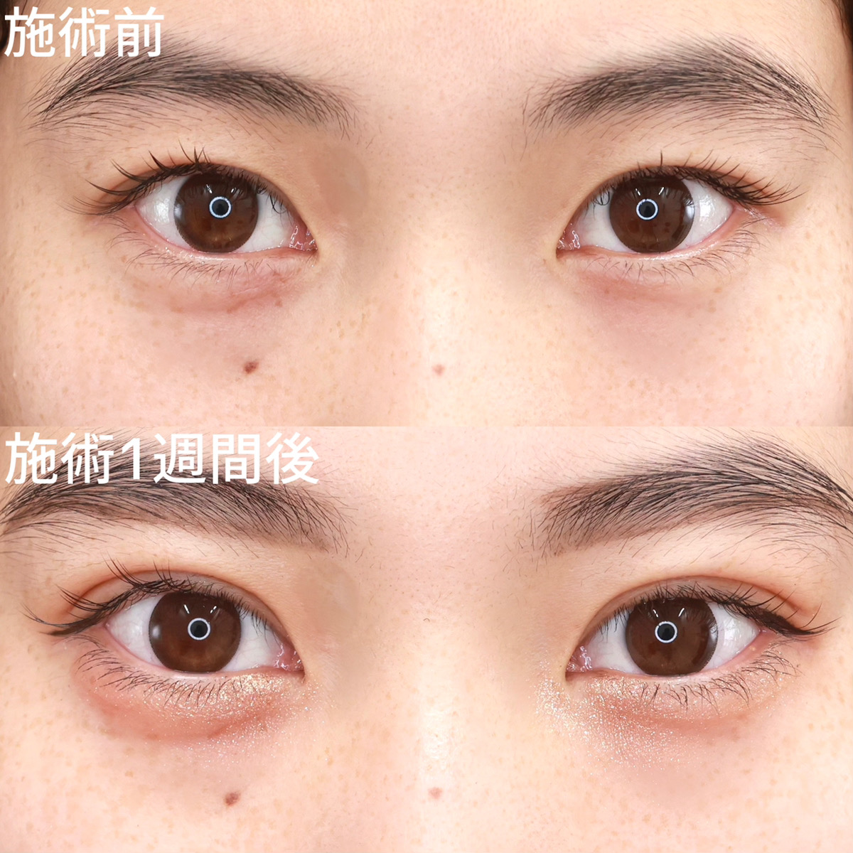 クイックコスメリングの症例写真 施術前後 