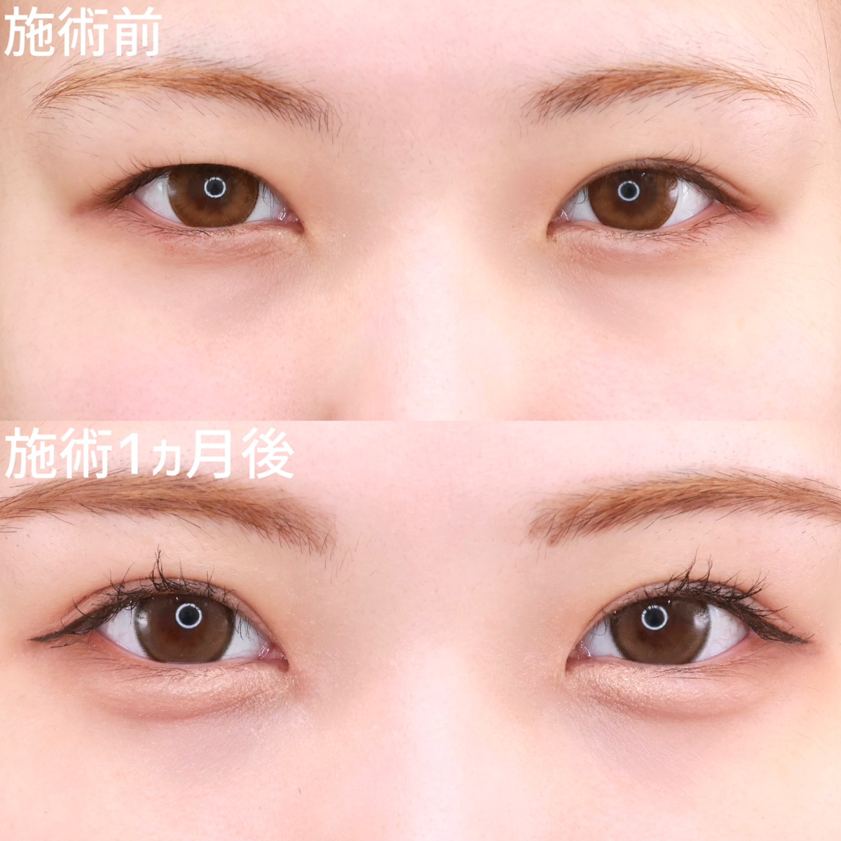 【二重埋没法】左右差を整え可愛さアップ！