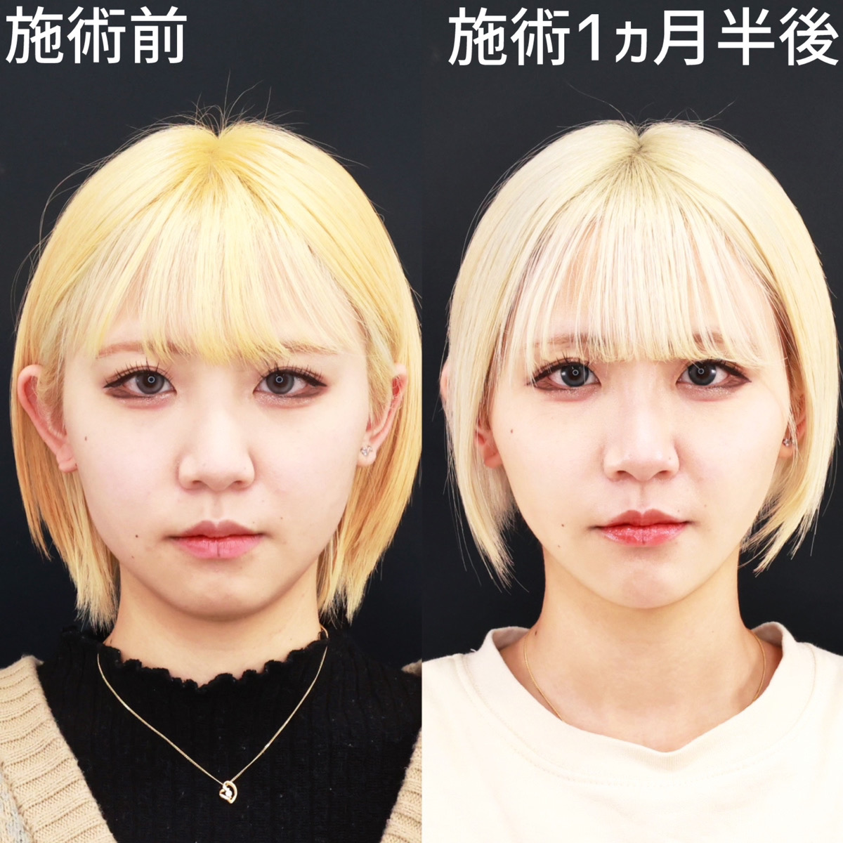 【糸リフト極】スッキリ小顔で垢抜け効果絶大！