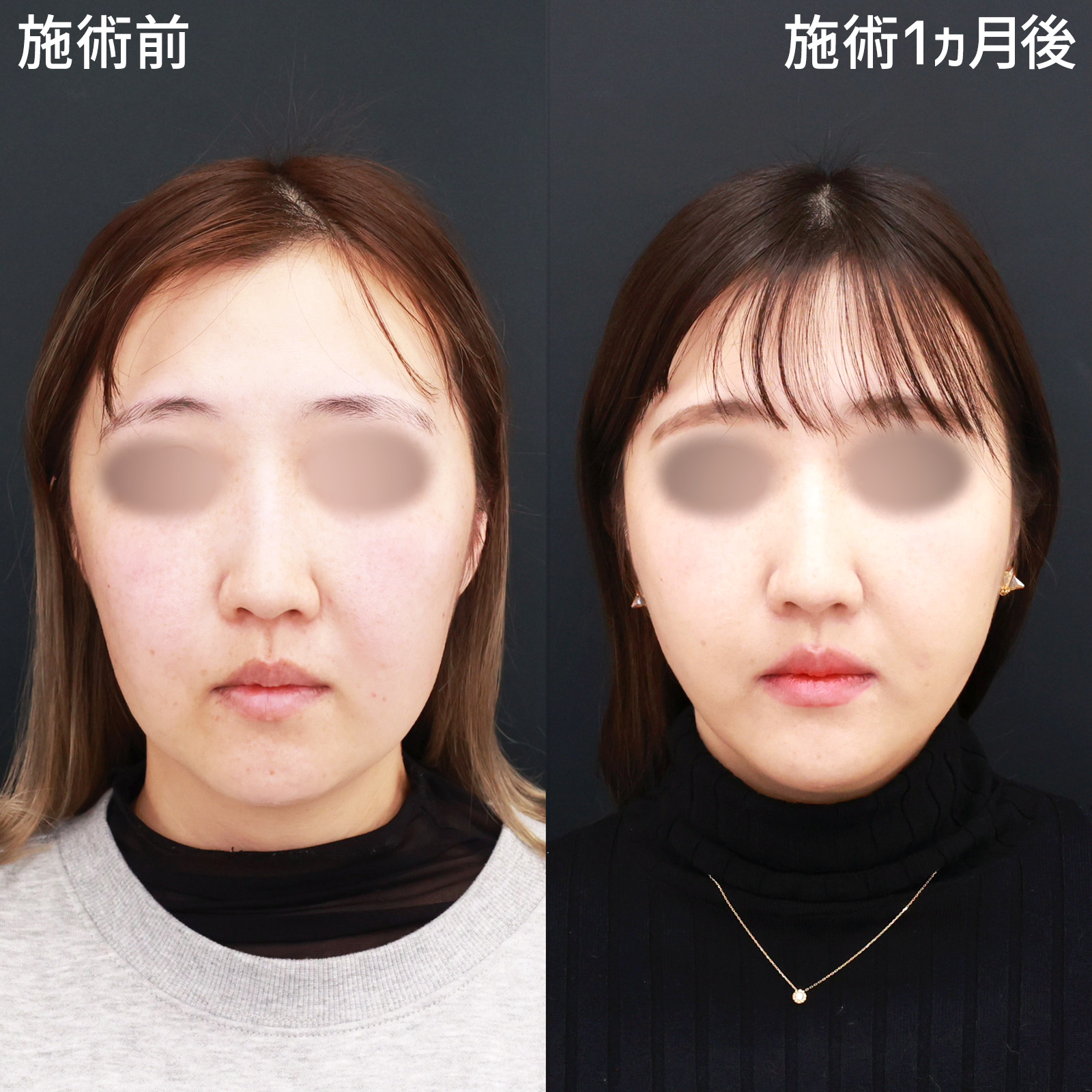 【糸リフト極】アンチエイジングなら小顔整形がおすすめ！