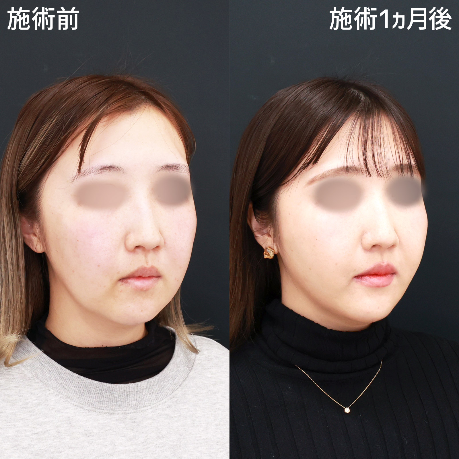 TAC式 ツヤ肌コラーゲンリフト®/ジョールファット除去/顎のヒアルロン酸注射の症例写真 施術前後 
