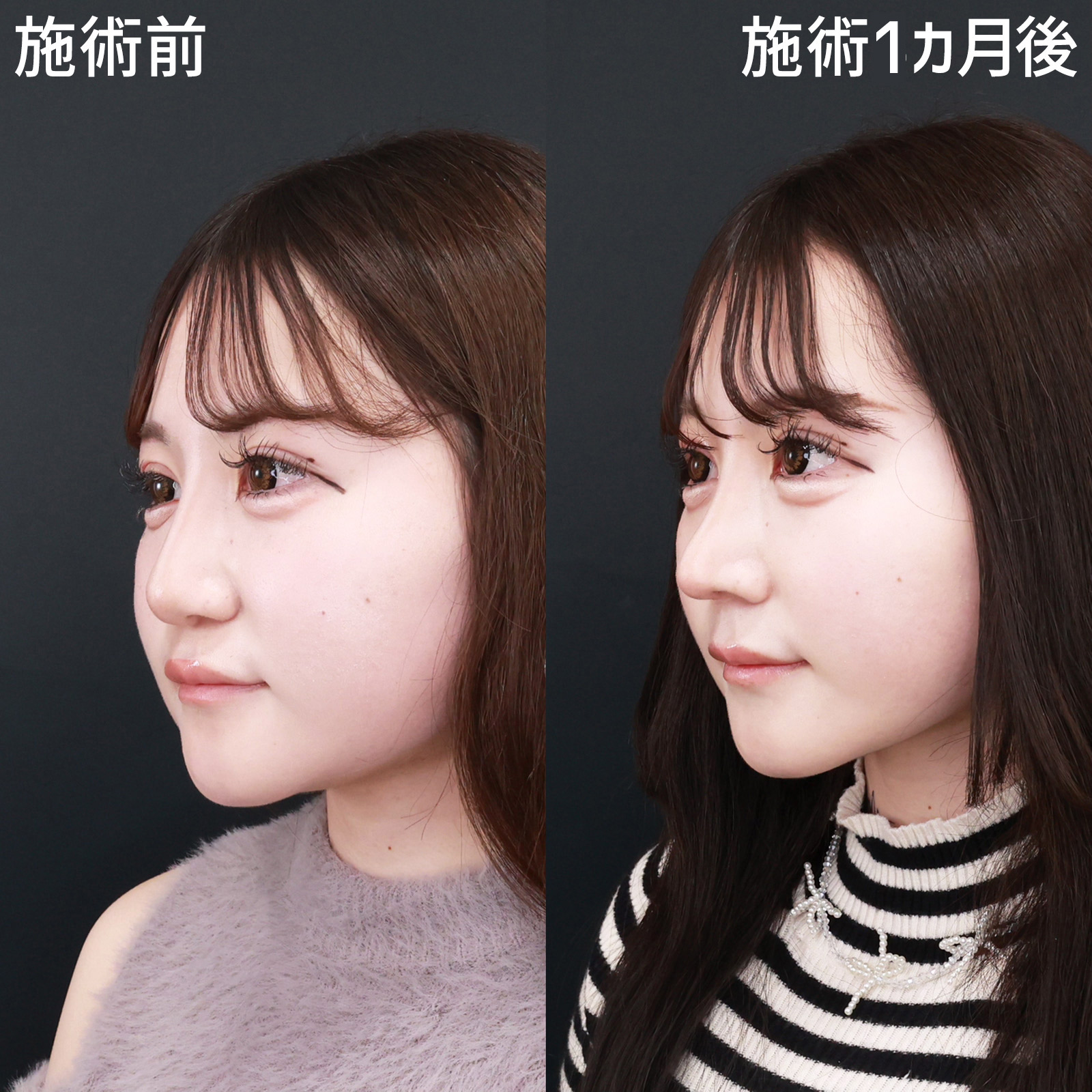 鼻中隔延長術/鼻尖形成・鼻尖縮小/鼻先軟骨移植の症例写真 施術前後 